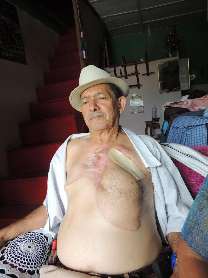 A don libardo le sacaron 3 costilla,las dos t ... ncer de mama duro 8 años con la enfermedad