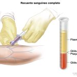 Diagnóstico y tratamiento oportuno, claves para tratar leucemia linfoblástica