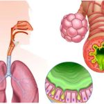 “Bronquitis aguda no obstructiva”