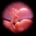Abortos